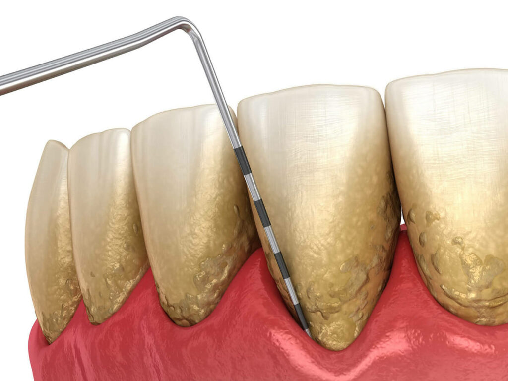 A close-up illustration of teeth with significant tartar buildup along the gum line. A dental probe is shown measuring the depth of the gum pocket between the teeth and the gums.